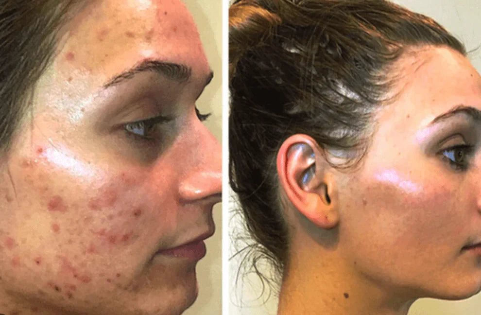 Bio Collagen Mask - Buy 1 Get 1 FREE